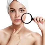 Melasma