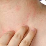 remedies to clear eczema scars