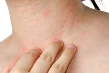 remedies to clear eczema scars