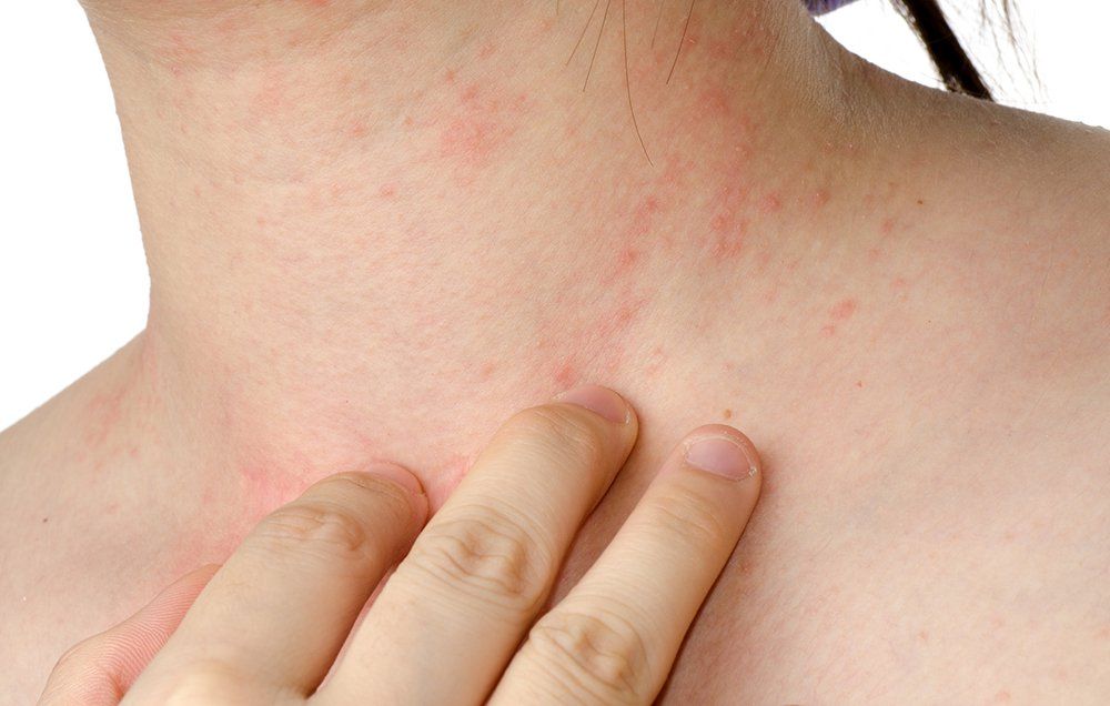 remedies to clear eczema scars